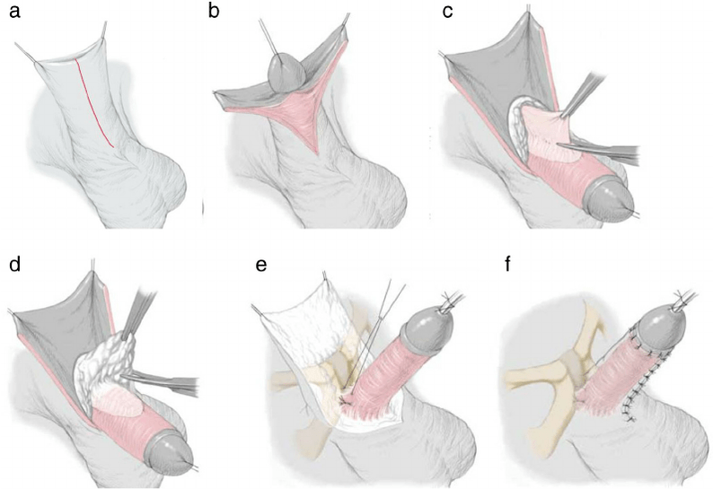 Cut the ligaments to enlarge the penis
